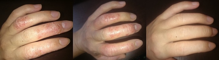 9月中旬から指のアトピーが悪化　約1か月の変化